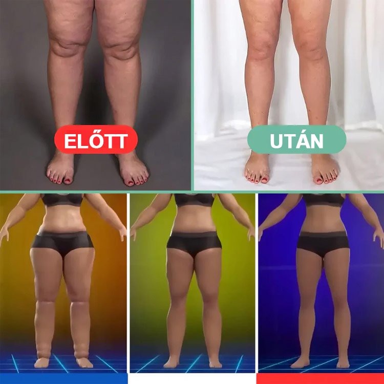 🔥Elektronikus limfavizeletű és cellulitisellenes masszírozó eszköz