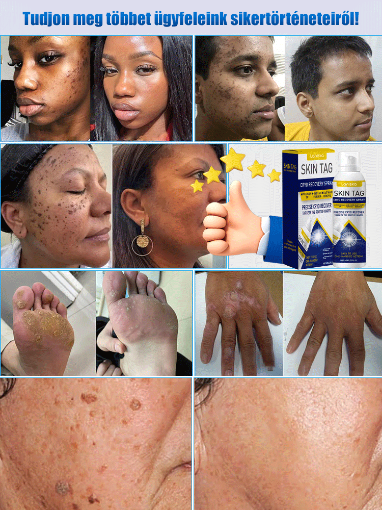 LANISKA szemölcs elleni külső ápoló spray