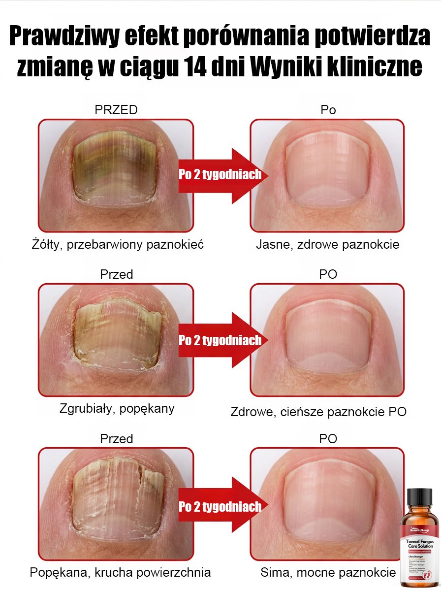 【Bezbolesna wymiana paznokci】Ziołowy łagodny płyn do naprawy paznokci dotkniętych grzybicą