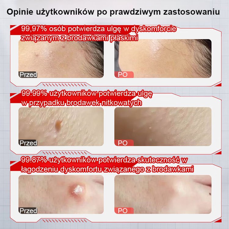 【Jednosekundowy usuwacz brodawek】Krem do usuwania brodawek